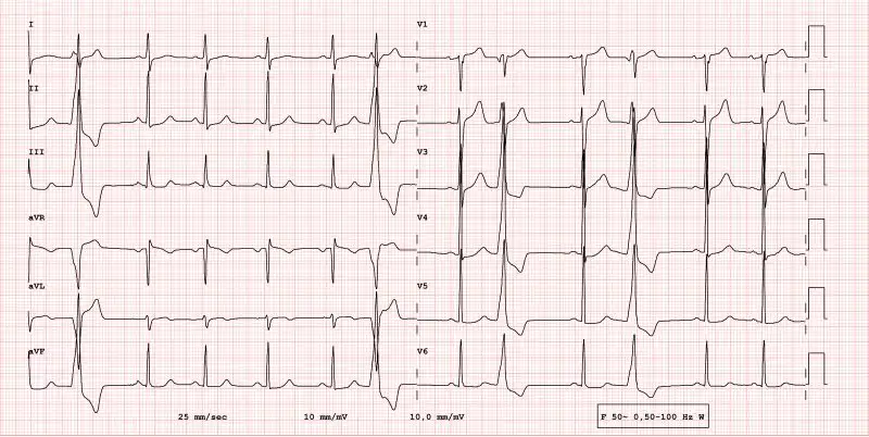 Elektrokardiogramm (EKG) mit mehreren Ableitungen und scharfen, gezackten Linien auf einem Gitterhintergrund